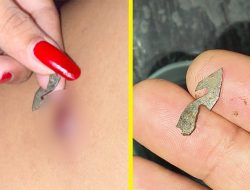 Diduga Malpraktik, Warga Rampoang Kaget Temukan Benda Asing di Luka Pascaoperasi di RSUD Palemmai Tandi